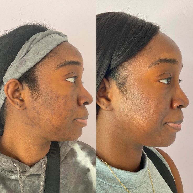 Before_and_After_Microneedling.jpg